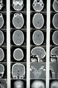 Can You Live A Normal Life After Brain Injury?