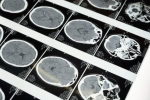 Multiple brain CT scan images showing head trauma and injury