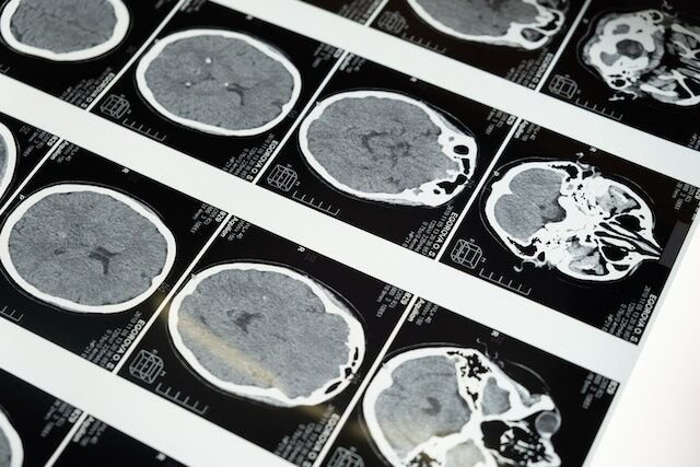 Orland Park Traumatic Brain Injury (TBI) Attorney - Michael J. Brennan Orland Park Traumatic Brain Injury (TBI) Attorney - Michael J. Brennan